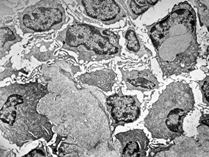 M,46y. | nuclear pseudoinclusion in plasmocyte - susp. amyloid … tonsillar tumor … Waldenström macroglobulinemia M,46y. | nuclear pseudoinclusion in plasmocyte - susp. amyloid … tonsillar tumor … Waldenström macroglobulinemia